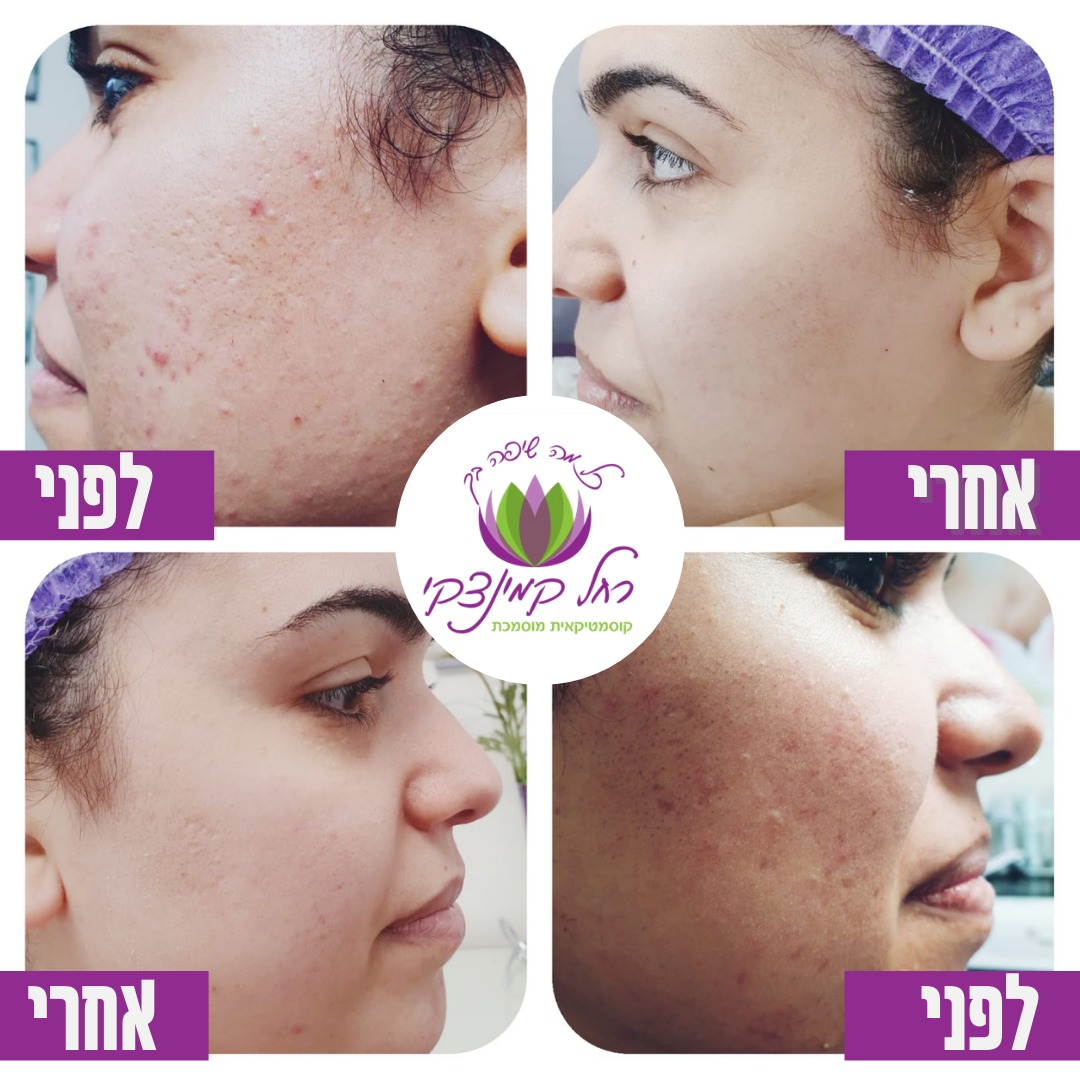 מומחית טיפולי אקנה